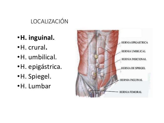 hernias inguinales